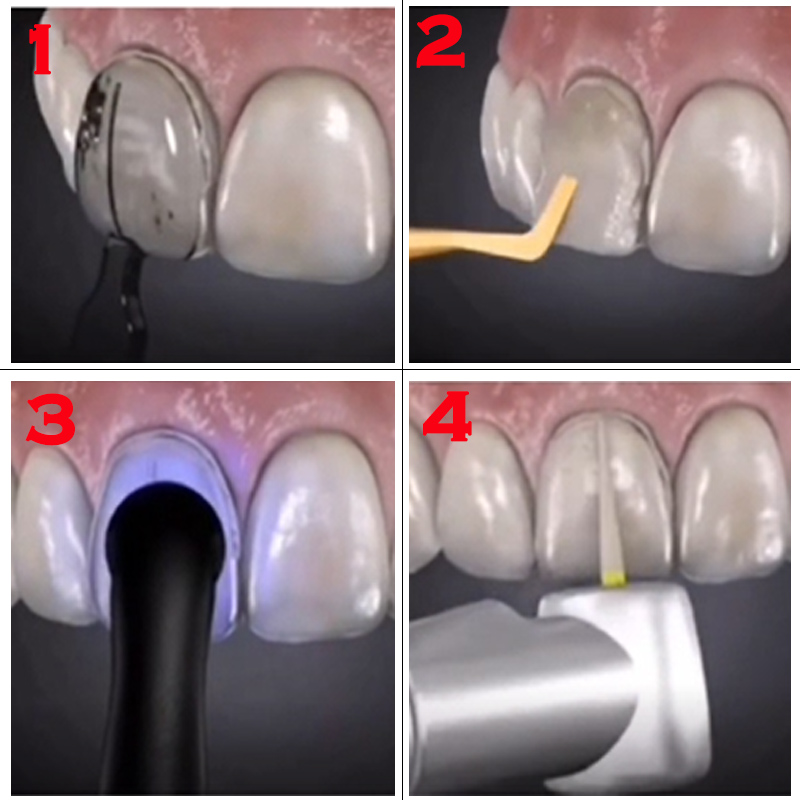 Autoklavierbare Dental-Furnier – Teeth Whitening Moulds Bewertung und Preis