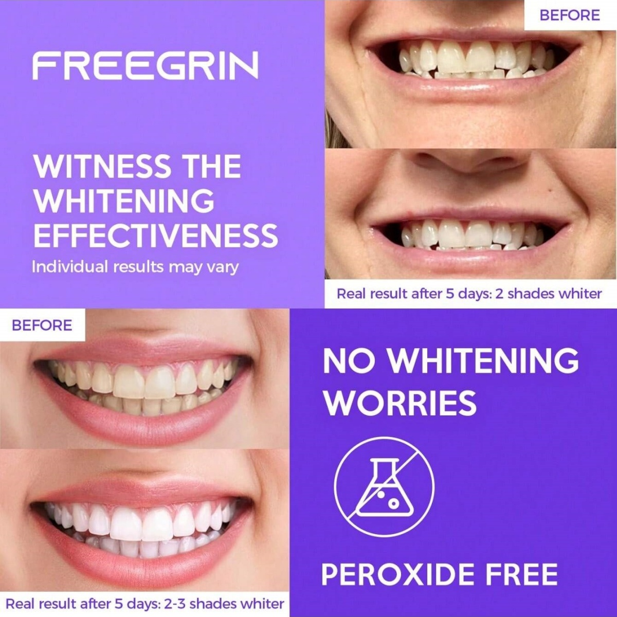 Deluxe Zahnaufhellungsaufklebe – Teeth Whitening Near Me Bewertung und Preis